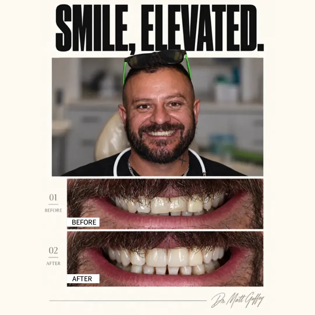 Smile Elevated Before and After-a