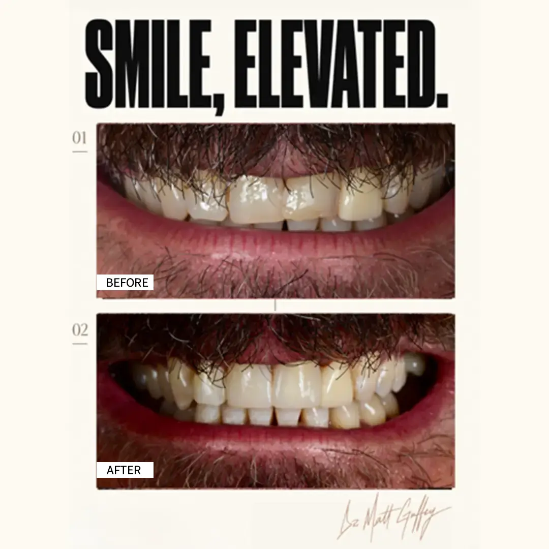 Smile Elevated Before and After-b