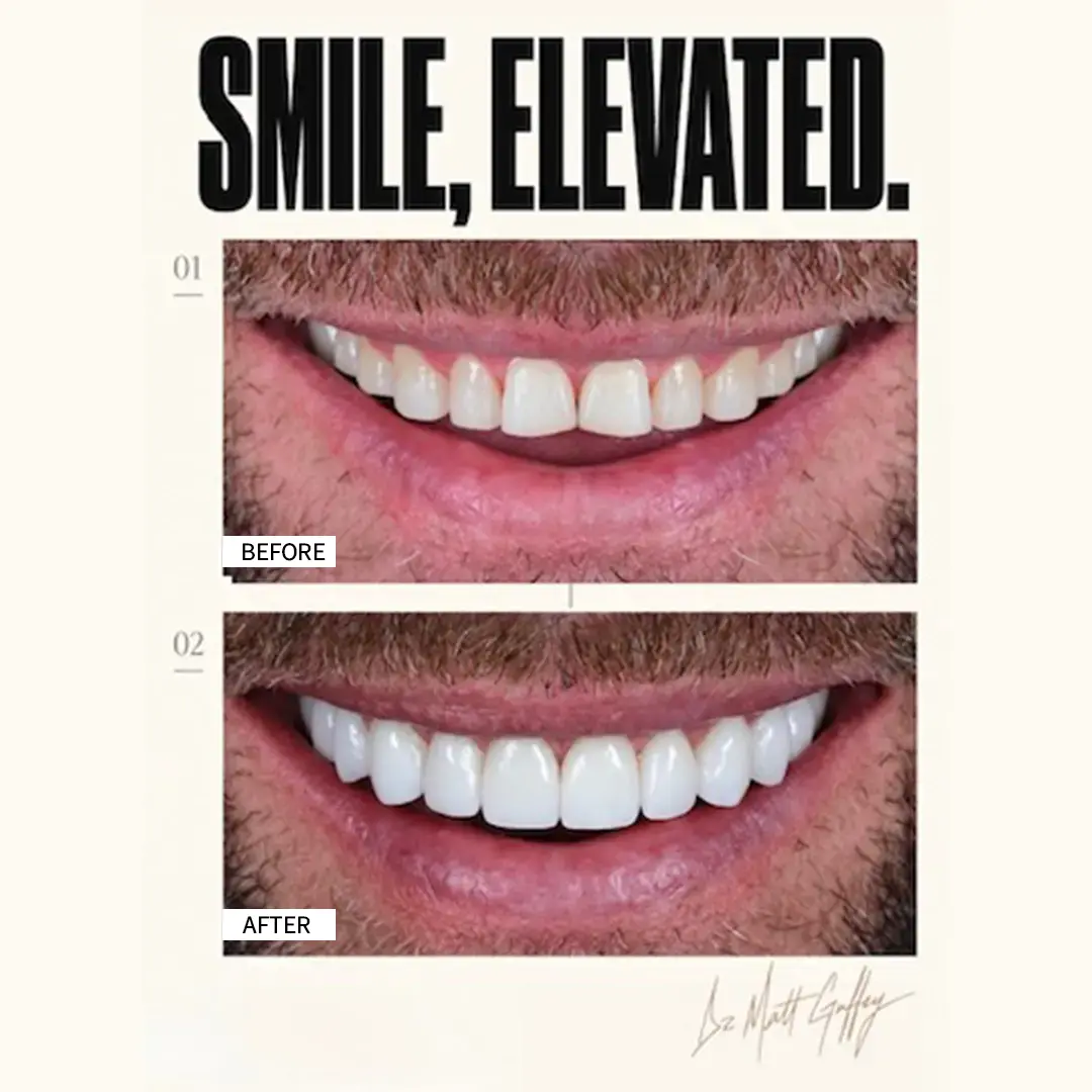 Smile Elevated Before and After-c