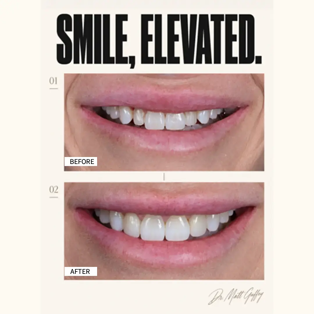 Smile Elevated Before and After-d