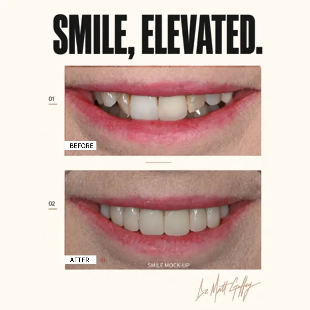 Smile Elevated Before and After-e