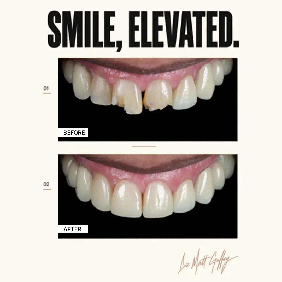 Smile Elevated Before and After-f