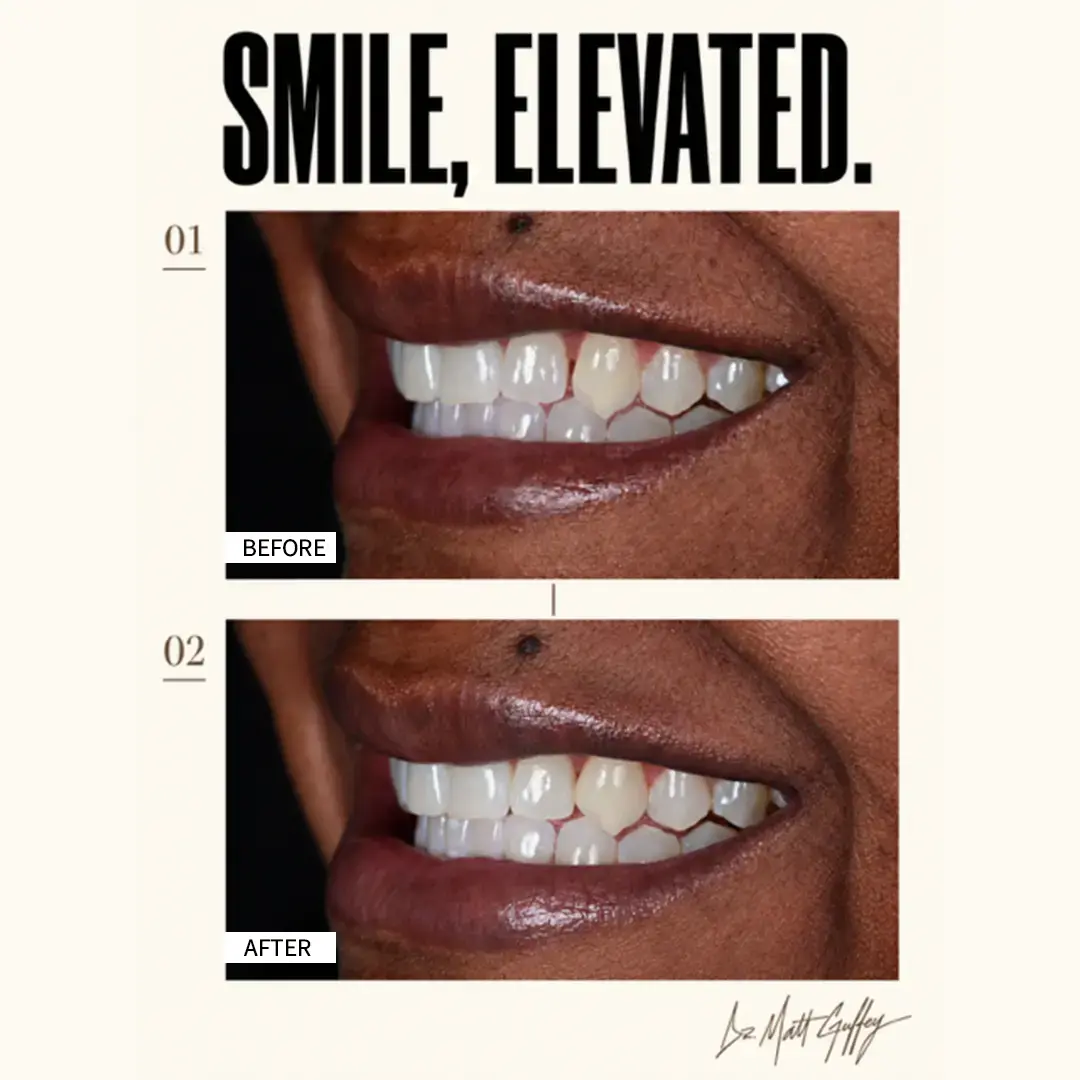 Smile Elevated Before and After-g