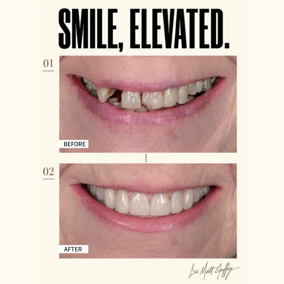 Smile Elevated Before and After-h