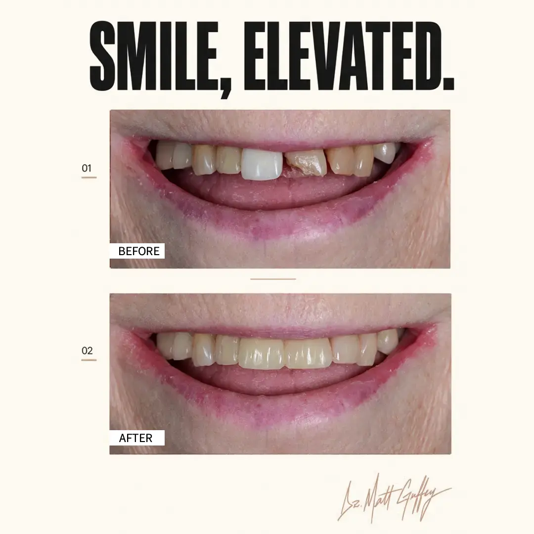 Smile Elevated Before and After-i