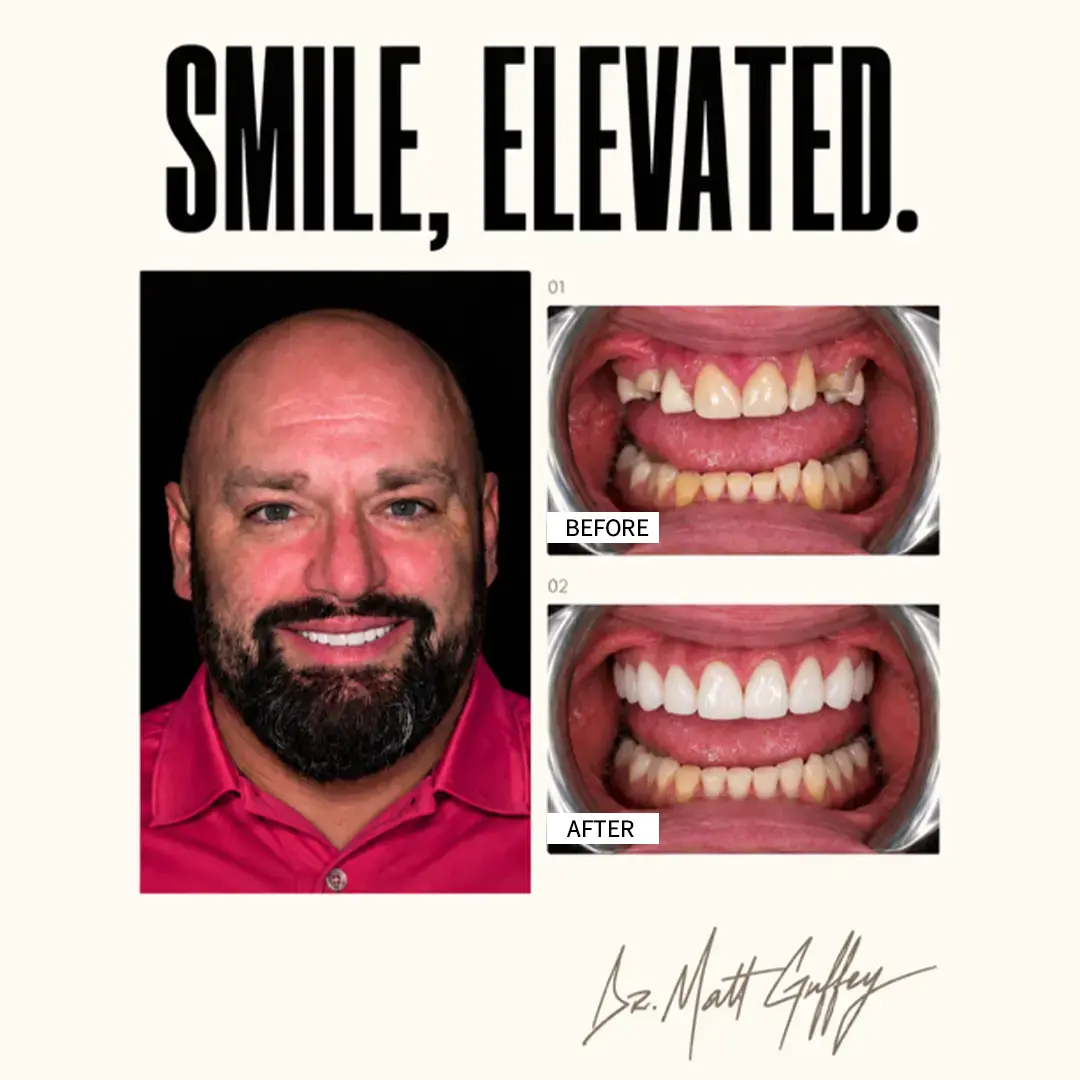 Smile Elevated Before and After-j