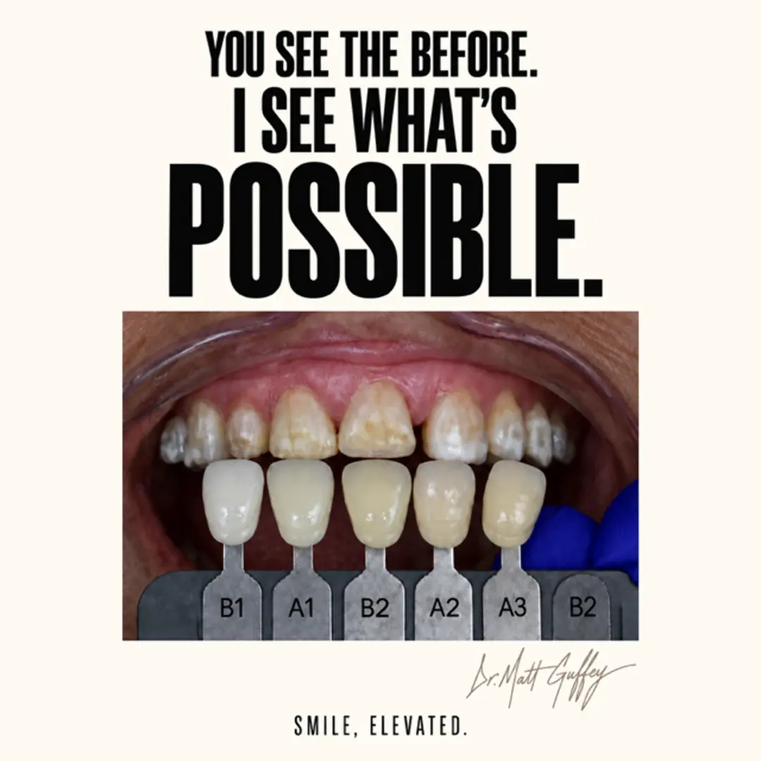 Smile Elevated Before and After-k