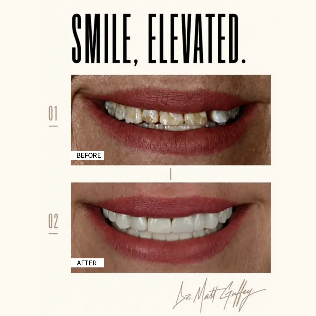 Smile Elevated Before and After-l