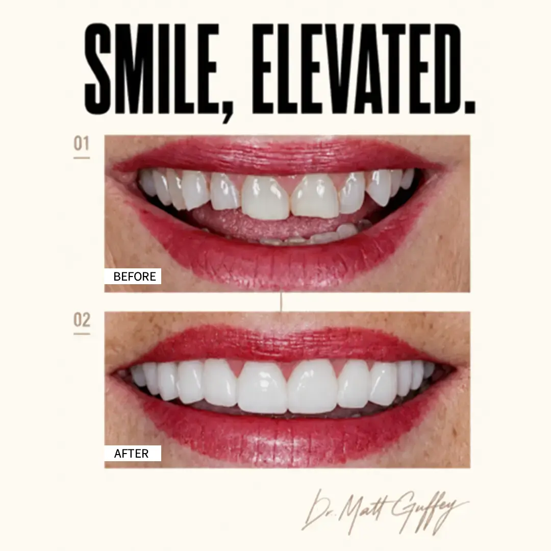 Smile Elevated Before and After-m