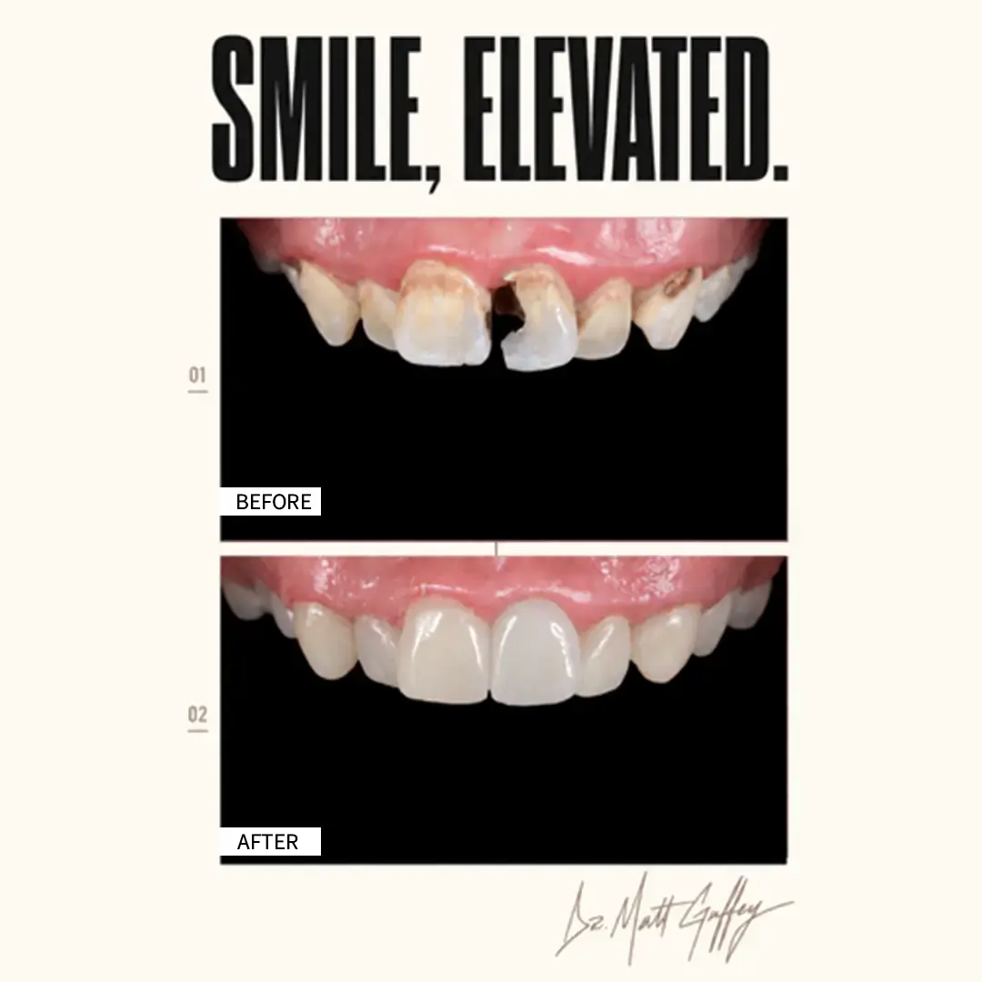 Smile Elevated Before and After-n