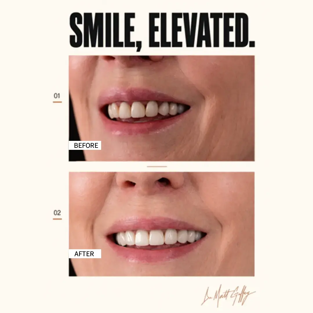 Smile Elevated Before and After-o