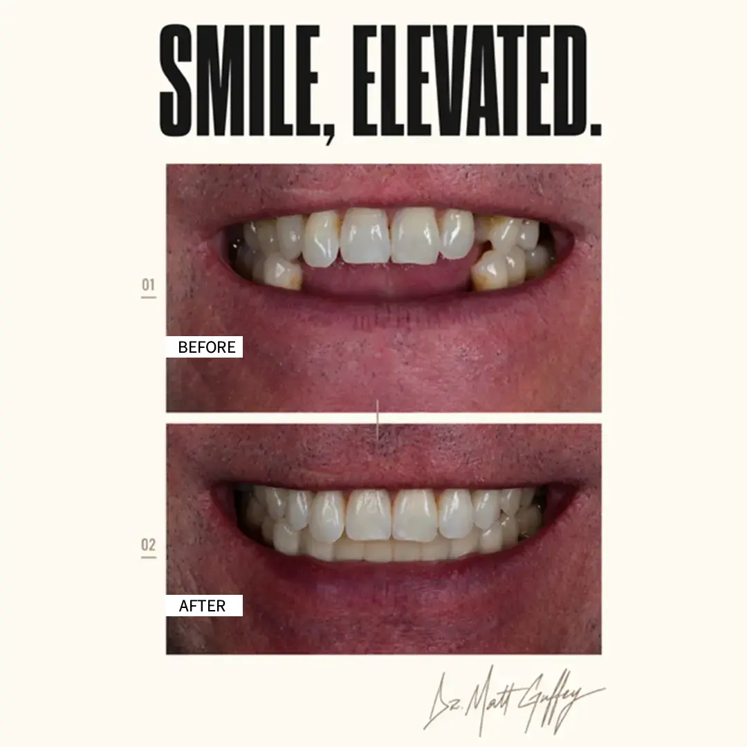 Smile Elevated Before and After-p