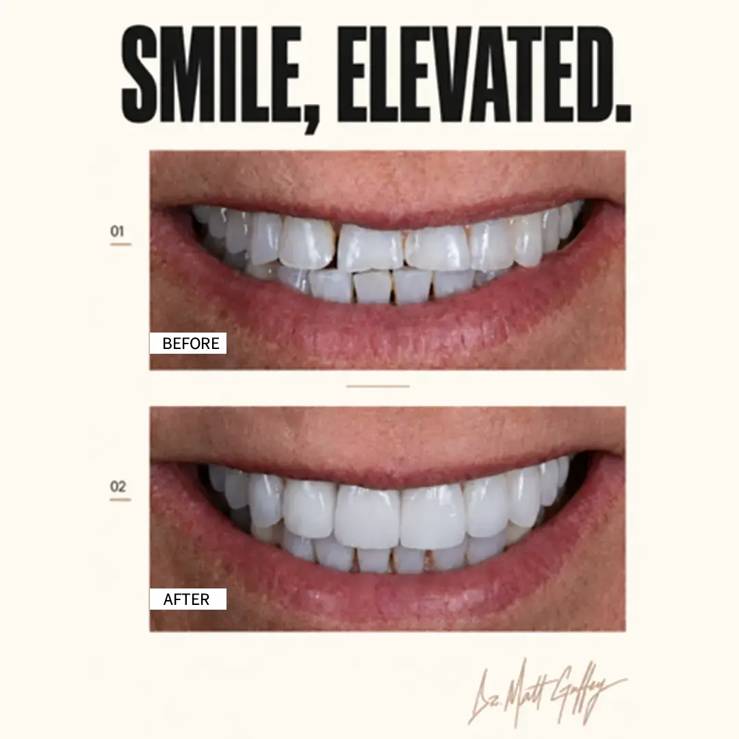 Smile Elevated Before and After-q