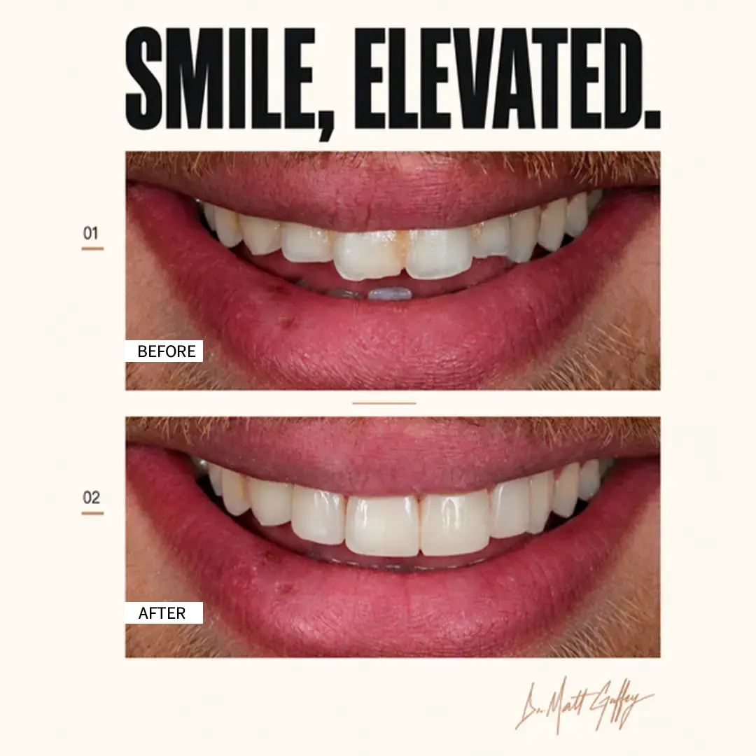 Smile Elevated Before and After-r