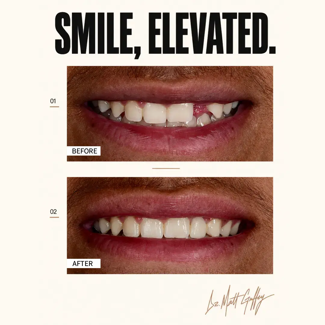 Smile Elevated Before and After-s
